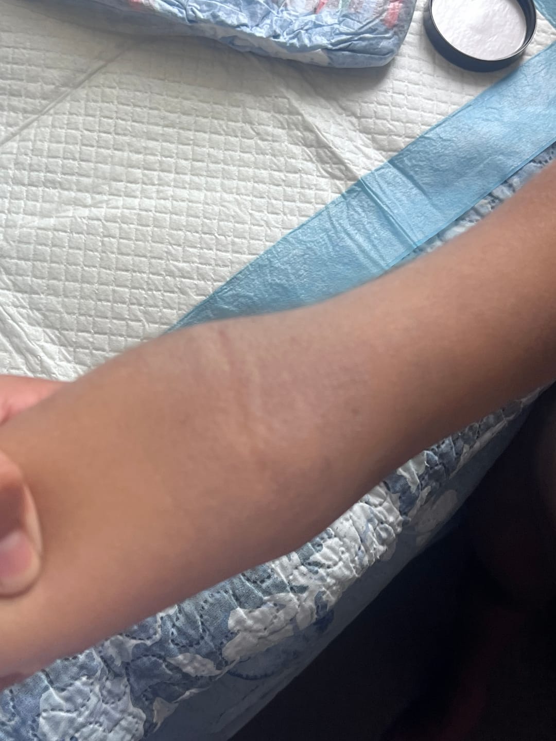 Customer photo review of Kawakawa Repair Balm - Winner, Best SOS/Healing Balm 2024