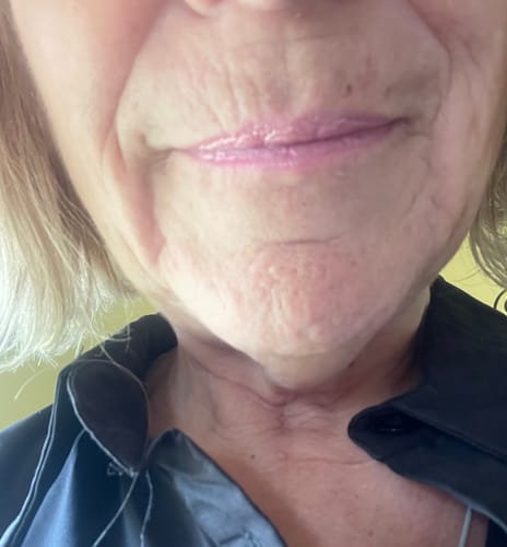 Customer photo review of Glov Micro Infusion System