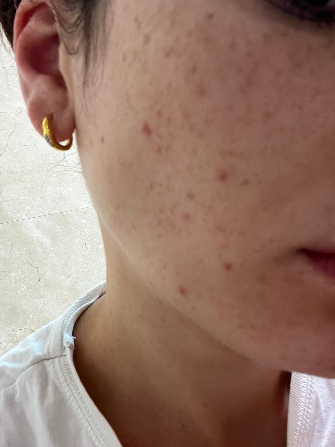 Customer photo review of MIRACLE H -  ÁCIDO HIPOCLOROSO - TÓNICO ANTIBACTERIANO Y ANTIINFLAMATORIO