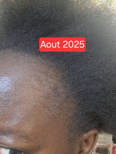 Customer photo review of Les Gummies - Croissance & volume cheveux