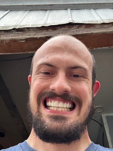 Customer photo review of Pop On Veneers with Impression Kit