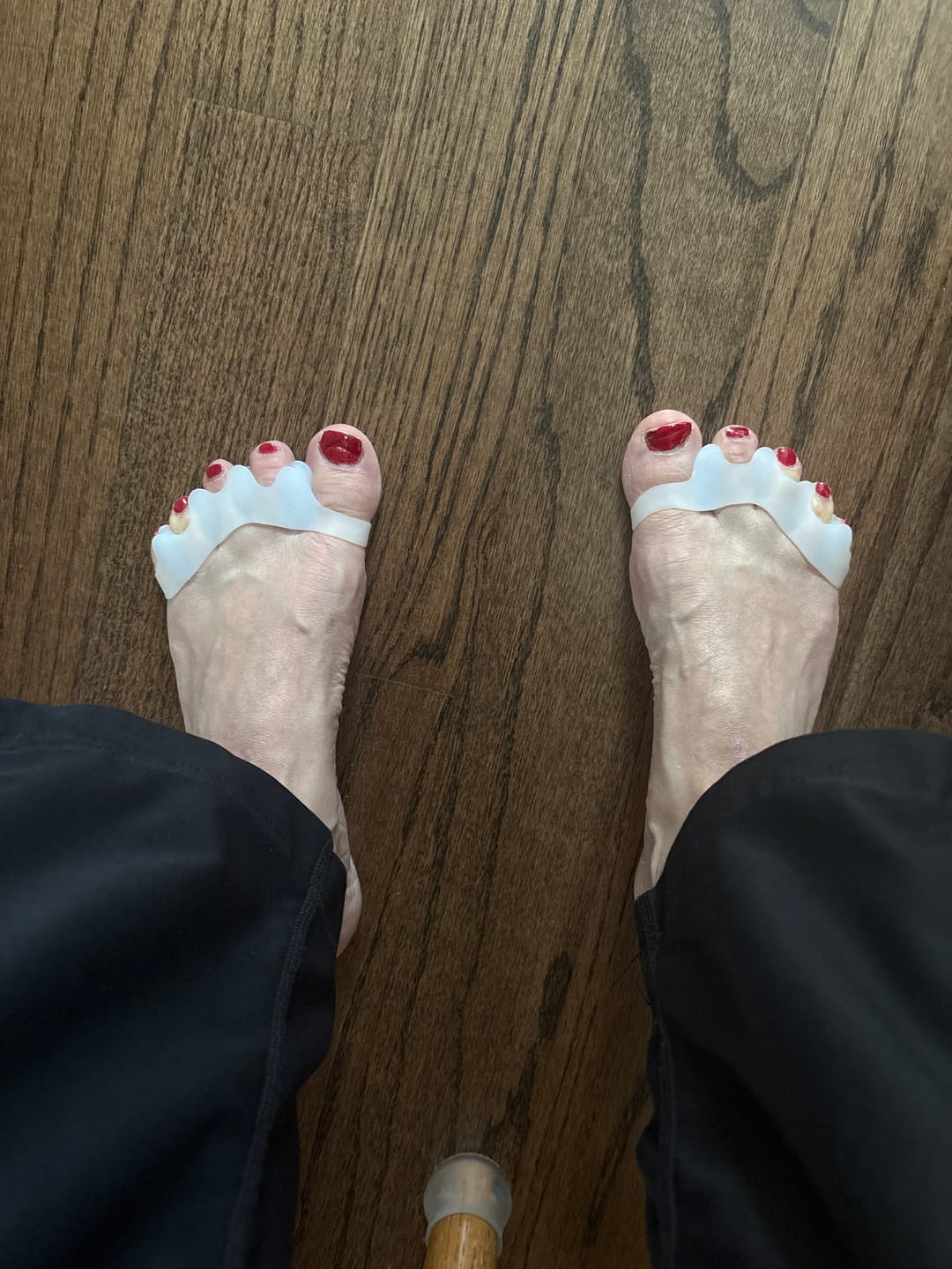 Customer photo review of Foot Toe Separator - Achieve Healthy Toes, Correct Bunions, Hammer Toes, and Relieve Foot Pain