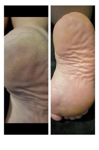 Customer photo review of LOVASKIN INSTANT FOOT PEEL Deluxe Kit - 25 applications or less than 3.20 per treatment