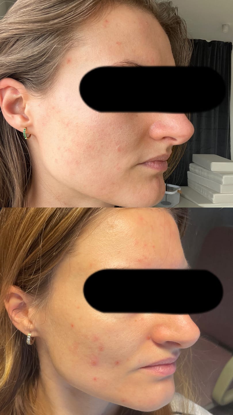 Customer photo review of Porenfeines 4% BHA PEELING