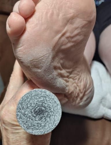 Customer photo review of ™Pedi - מכונה להסרת עור יבש וסדקים בכפות הרגליים