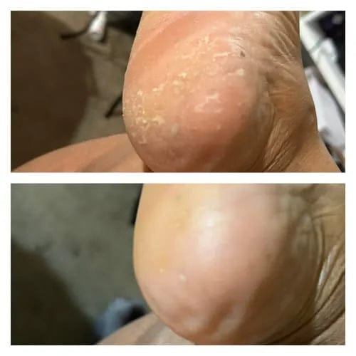 Customer photo review of ™Pedi - מכונה להסרת עור יבש וסדקים בכפות הרגליים