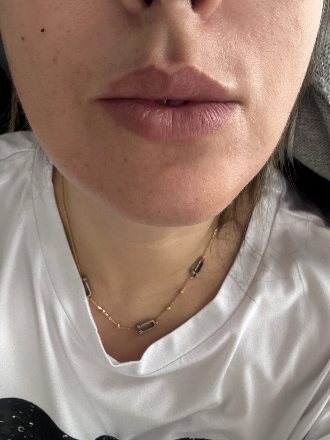 Customer photo review of Forfaits Avantages + Épilation Laser Clarity II
