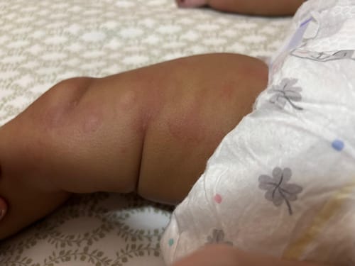 Customer photo review of All Over Ointment Eczema Treatment