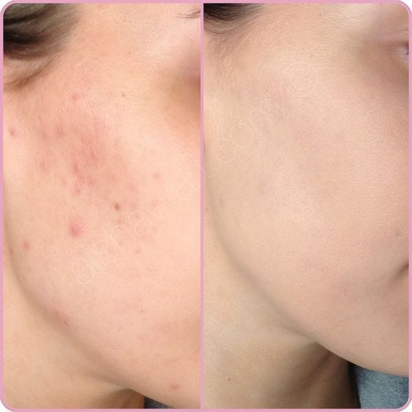 Customer photo review of Spectra Matt SC SPF 40