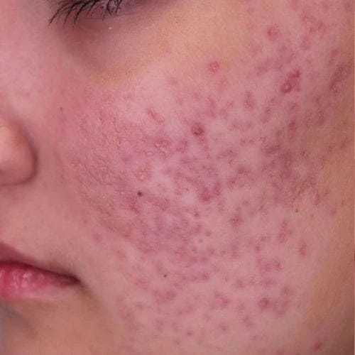 Customer photo review of PDRN Micro-Infusion Skin Booster