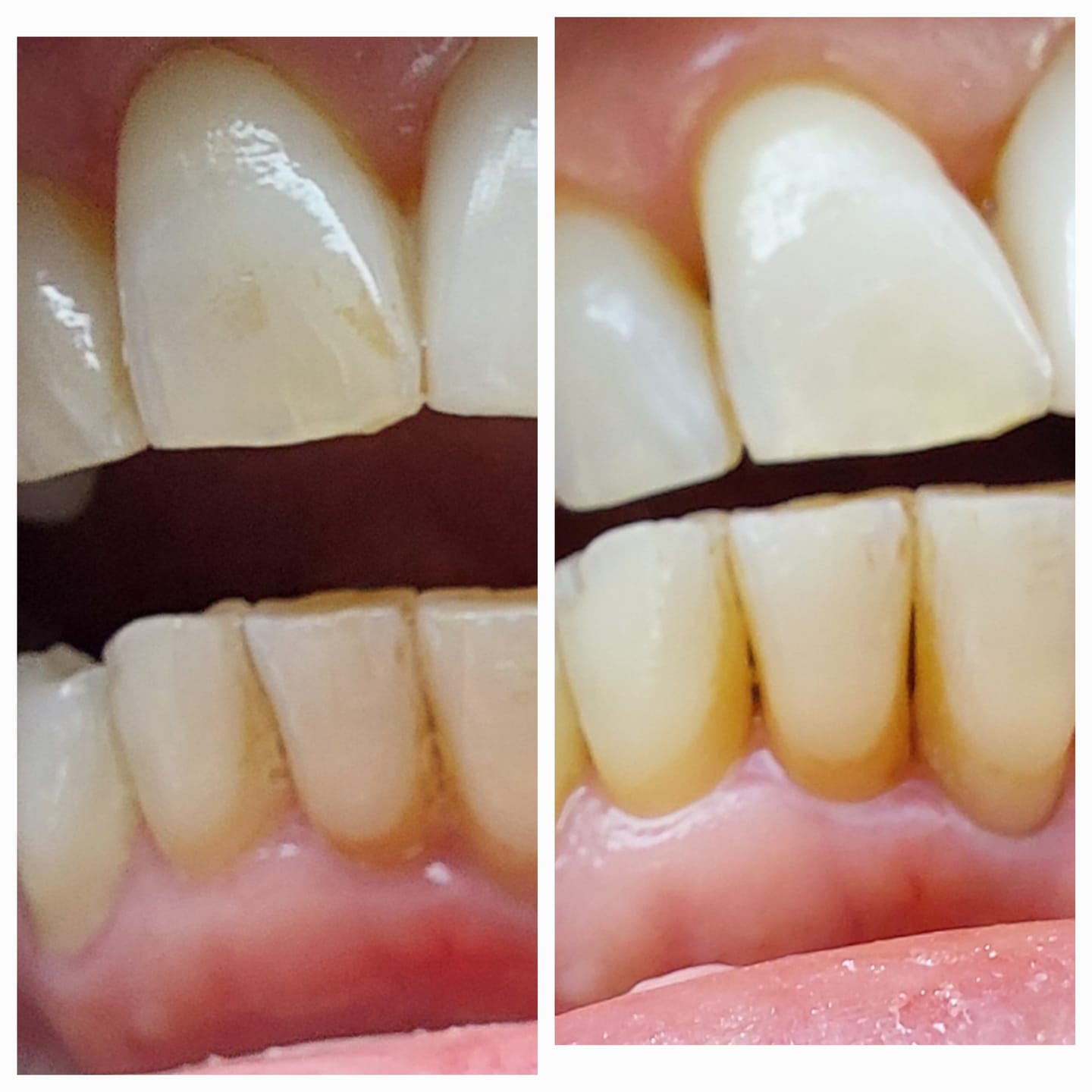 Customer photo review of Sensitive Teeth Whitening Toothpaste
