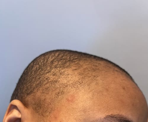 Customer photo review of Minoxidil High Strength (5%) SOLUTION, 3x60ml pack