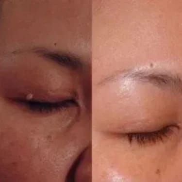 Customer photo review of Bőrkinövés Eltávolító Készlet