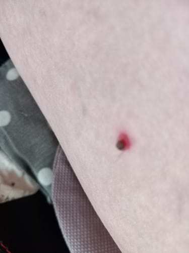Customer photo review of Bőrkinövés Eltávolító Készlet
