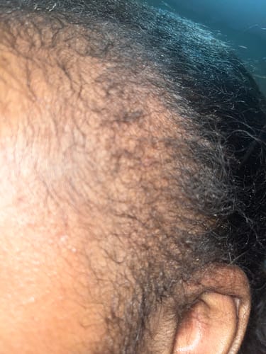 Customer photo review of Minoxidil High Strength (5%) SOLUTION, 3x60ml pack