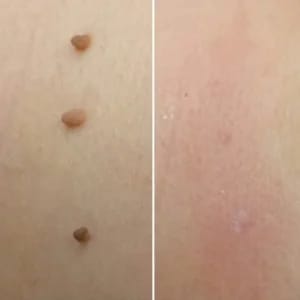 Customer photo review of Bőrkinövés Eltávolító Készlet