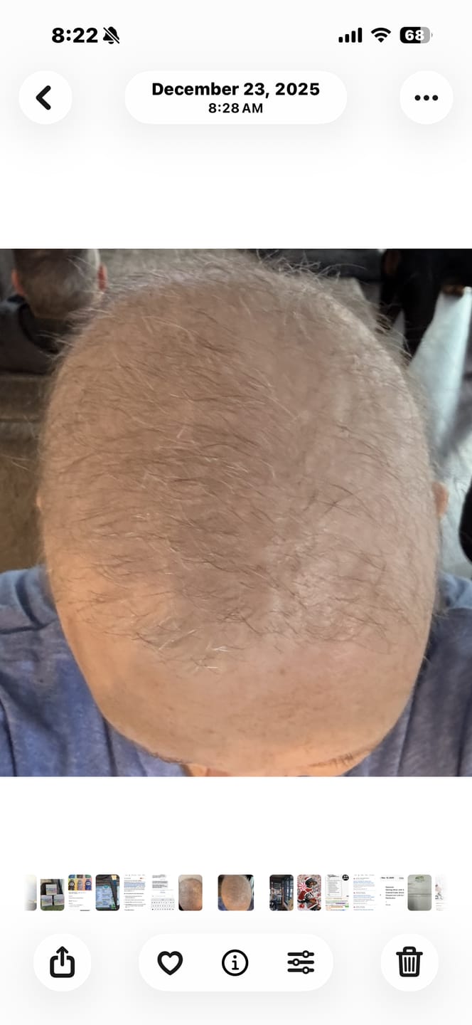 Customer photo review of Hair Growth Hero Bundle