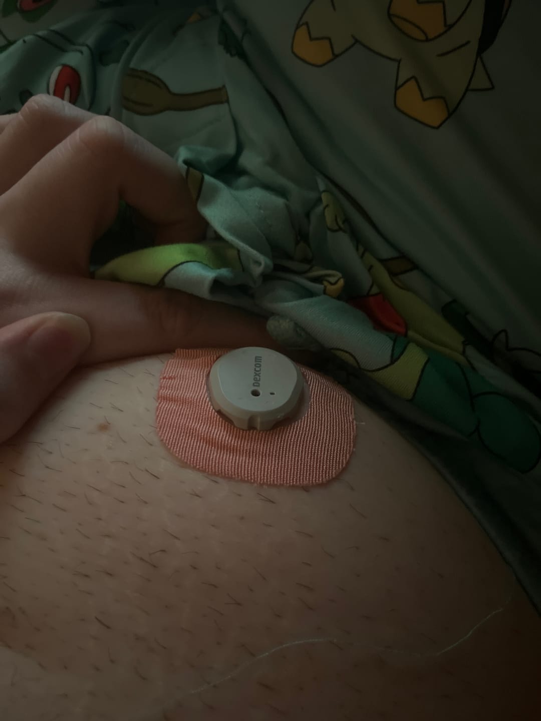 Customer photo review of Skin Grip Original - Dexcom G7 & Stelo Adhesive Patches (With Cutout)