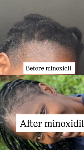 Customer photo review of Minoxidil 5% Solution, 1 Pack 60ml