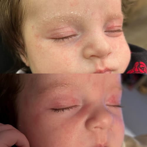 Customer's before-and-after image of a baby's facial eczema, showing less redness and flaking after using Calm Balm.