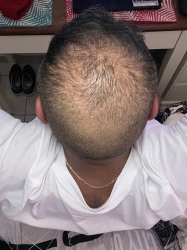 Customer photo review of Minoxidil DOUBLE ACTION FOAM, MEN ONLY 3x60ml Pack