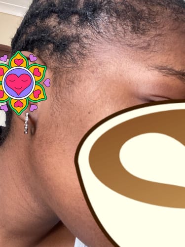 Customer photo review of Minoxidil High Strength (5%) SOLUTION, 3x60ml pack