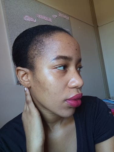 Customer photo review of Minoxidil High Strength (5%) SOLUTION, 3x60ml pack