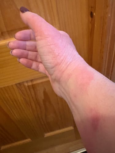 Reviewer's arm before using the Calm Skin-Relief Kit, showing a large, red patch of irritated skin.