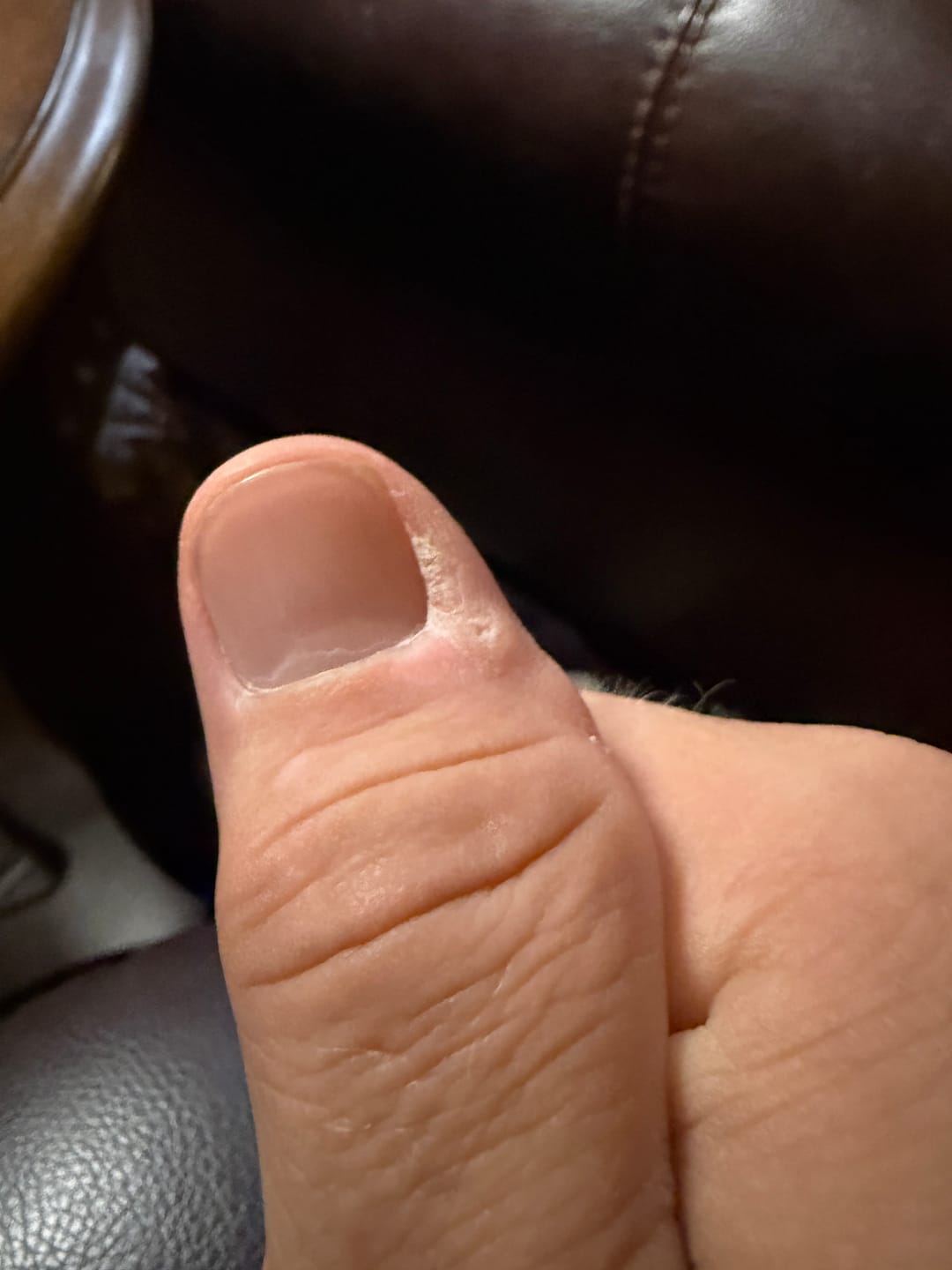 Customer photo review of The Wartabater | Precision Wart  Tool