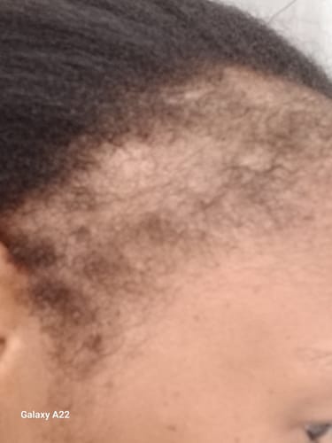 Customer photo review of Minoxidil REGULAR (2%) strength FOAM, 1x60ml pack