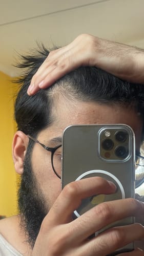 Customer photo review of Minoxidil DOUBLE ACTION Solution - MEN ONLY, 3x60ml pack