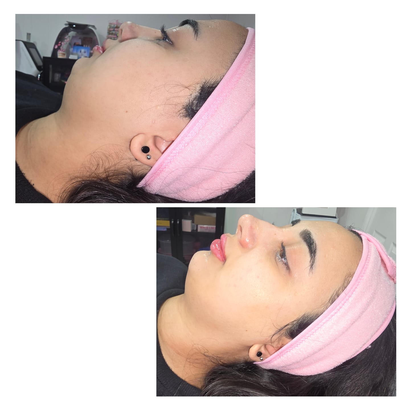 Customer photo review of INIA Microcurrent Sculpting Duo