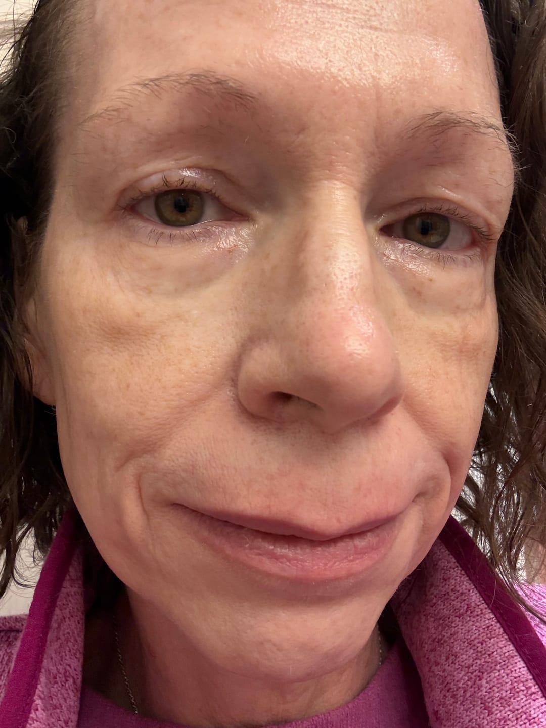 Customer photo review of HYDRATING CREAM | BARRIER SUPPORT