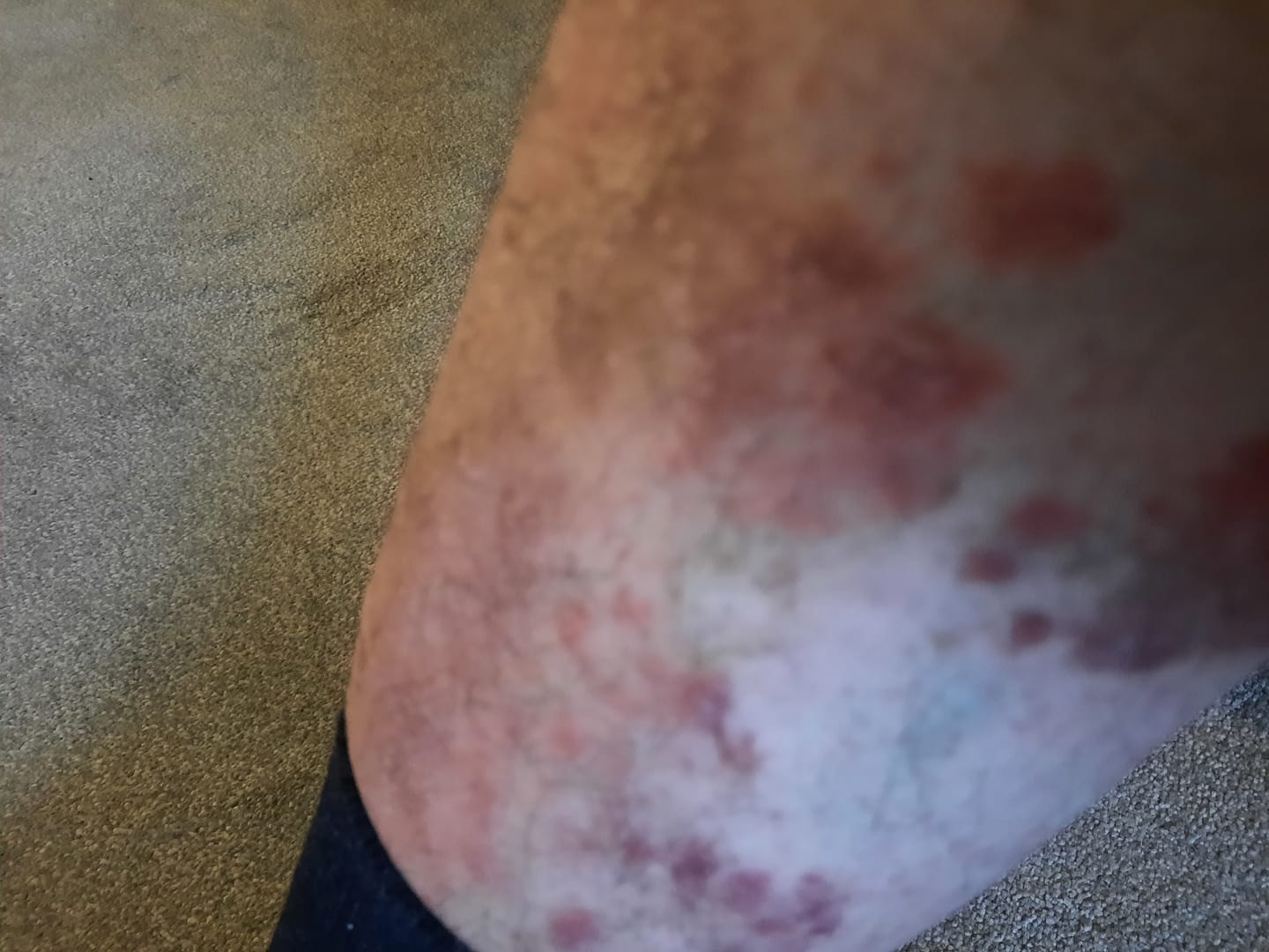 Customer photo review of Large Bioskin Duo Pack