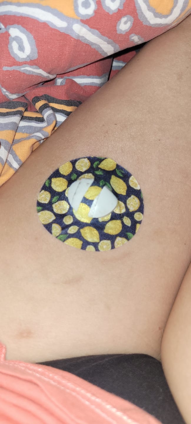 Customer photo review of Medtronic Guardian 4 Lemon CGM-Sensor overpatches