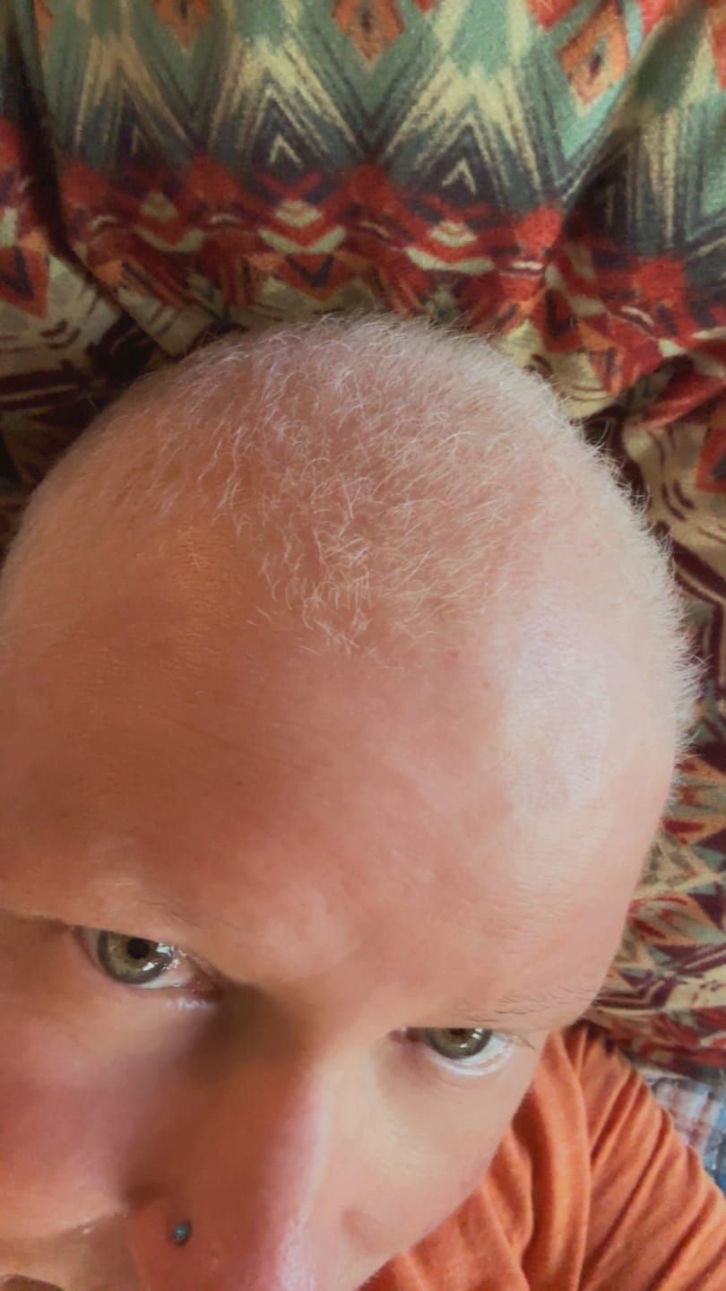 Customer photo review of Hair Growth Hero Bundle