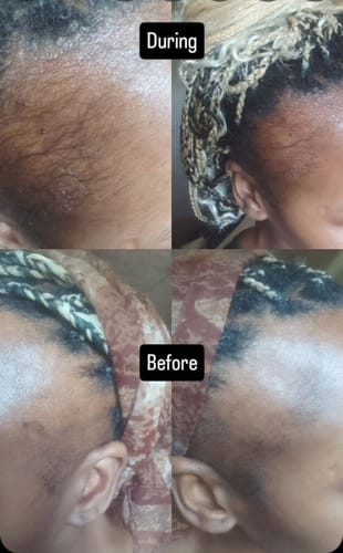 Customer photo review of Minoxidil High Strength (5%) SOLUTION, 3x60ml pack