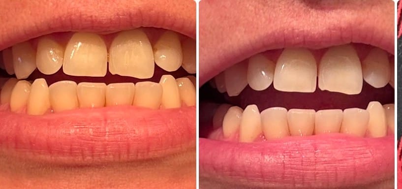 Customer photo review of Pack Bandes Violettes : 2 Paquets de Bandes Violettes Kauka Smile (sans peroxyde)