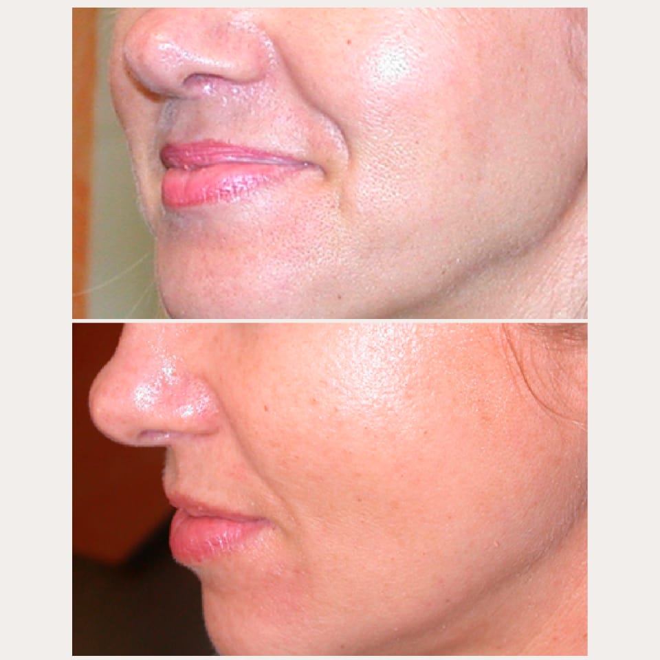 Customer photo review of Microneedling - Lifting Power Set – Professionelles Micro-Infusion Treatment für Zuhause