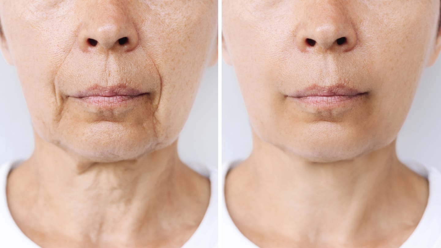 Customer photo review of Microneedling - Lifting Power Set – Professionelles Micro-Infusion Treatment für Zuhause