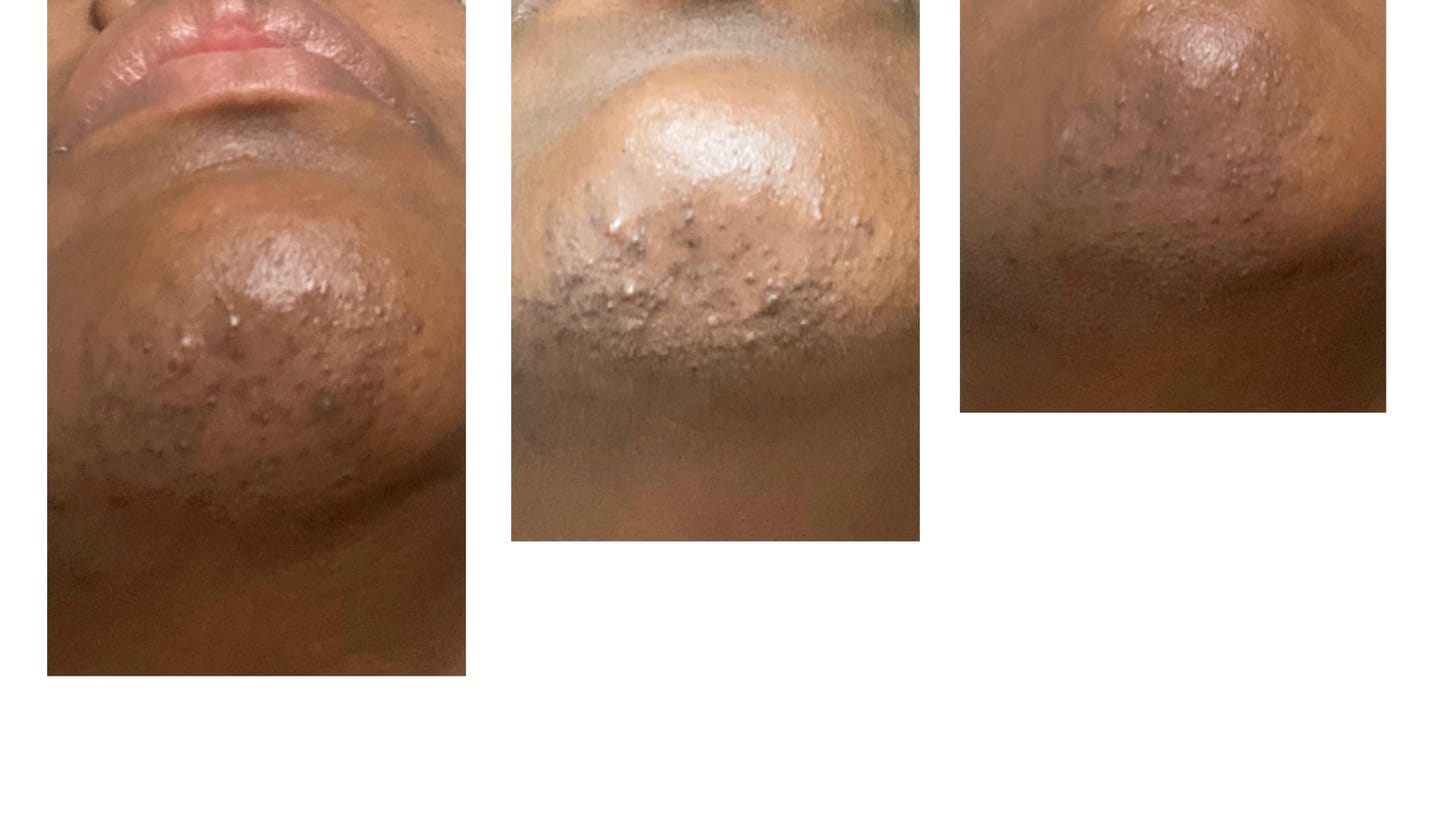 Customer photo review of Facial Moisturizer (Ingrown Hair/Acne)