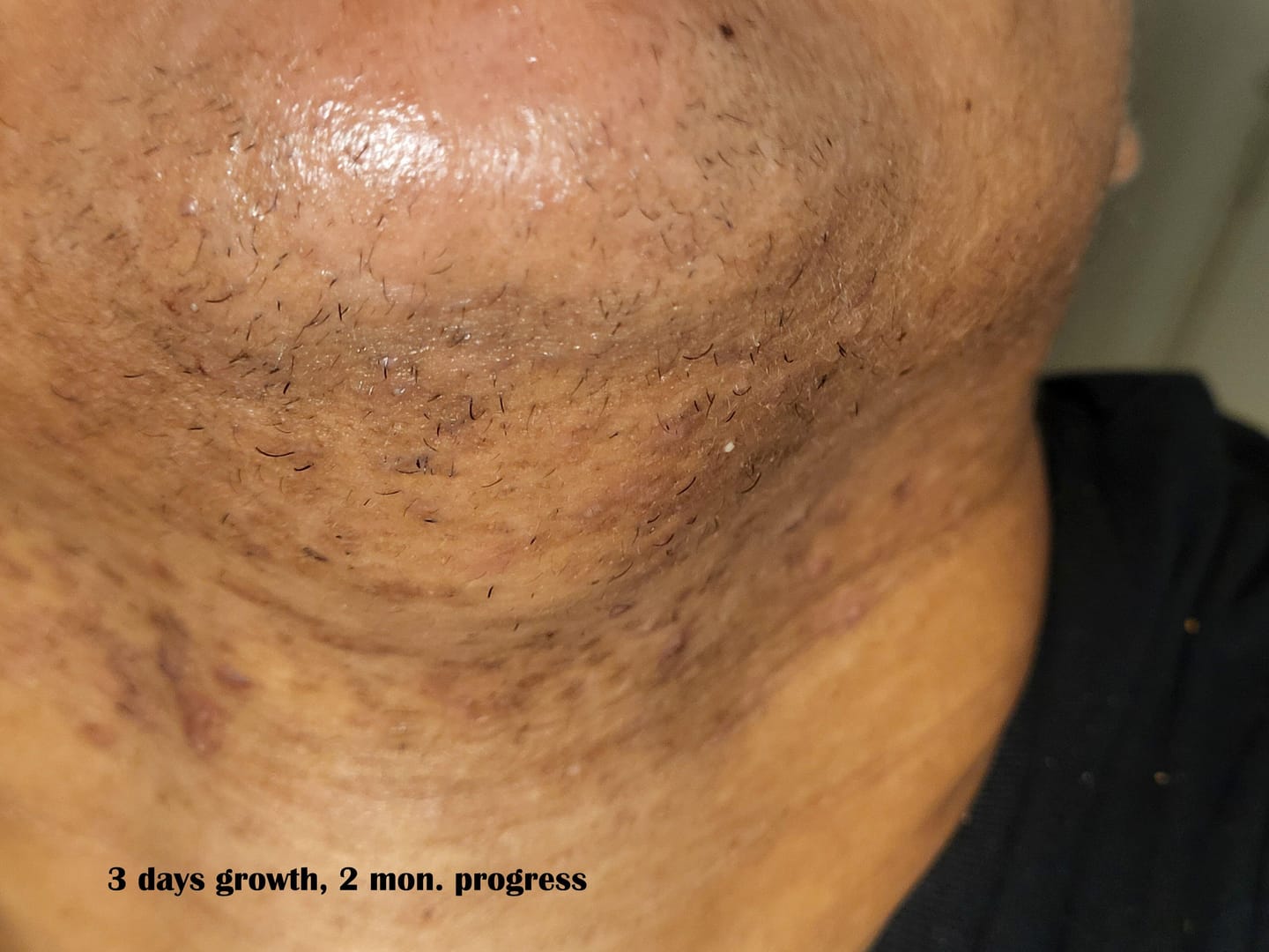 Customer photo review of Hair Reducing Fade Oil - Slows Growth, Thins, and Reduces Hair Naturally