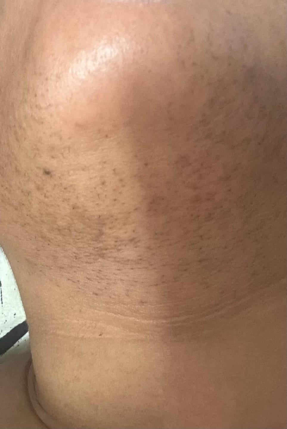 Customer photo review of Hair Reducing Fade Oil - Slows Growth, Thins, and Reduces Hair Naturally