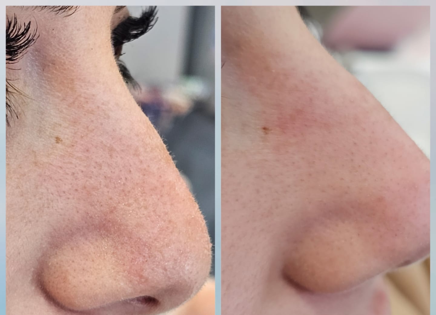 Customer photo review of OroSkin Pore-fection Blackhead Remover
