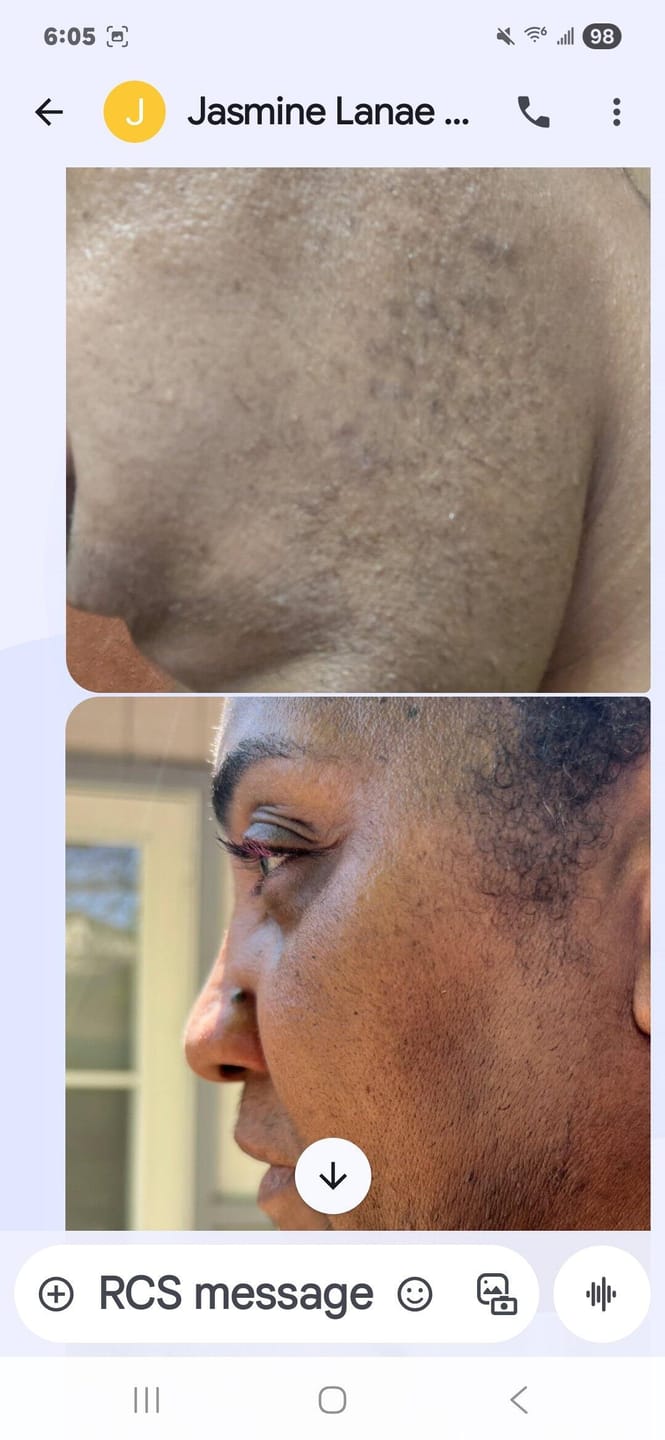 Customer photo review of Facial Moisturizer (Ingrown Hair/Acne)