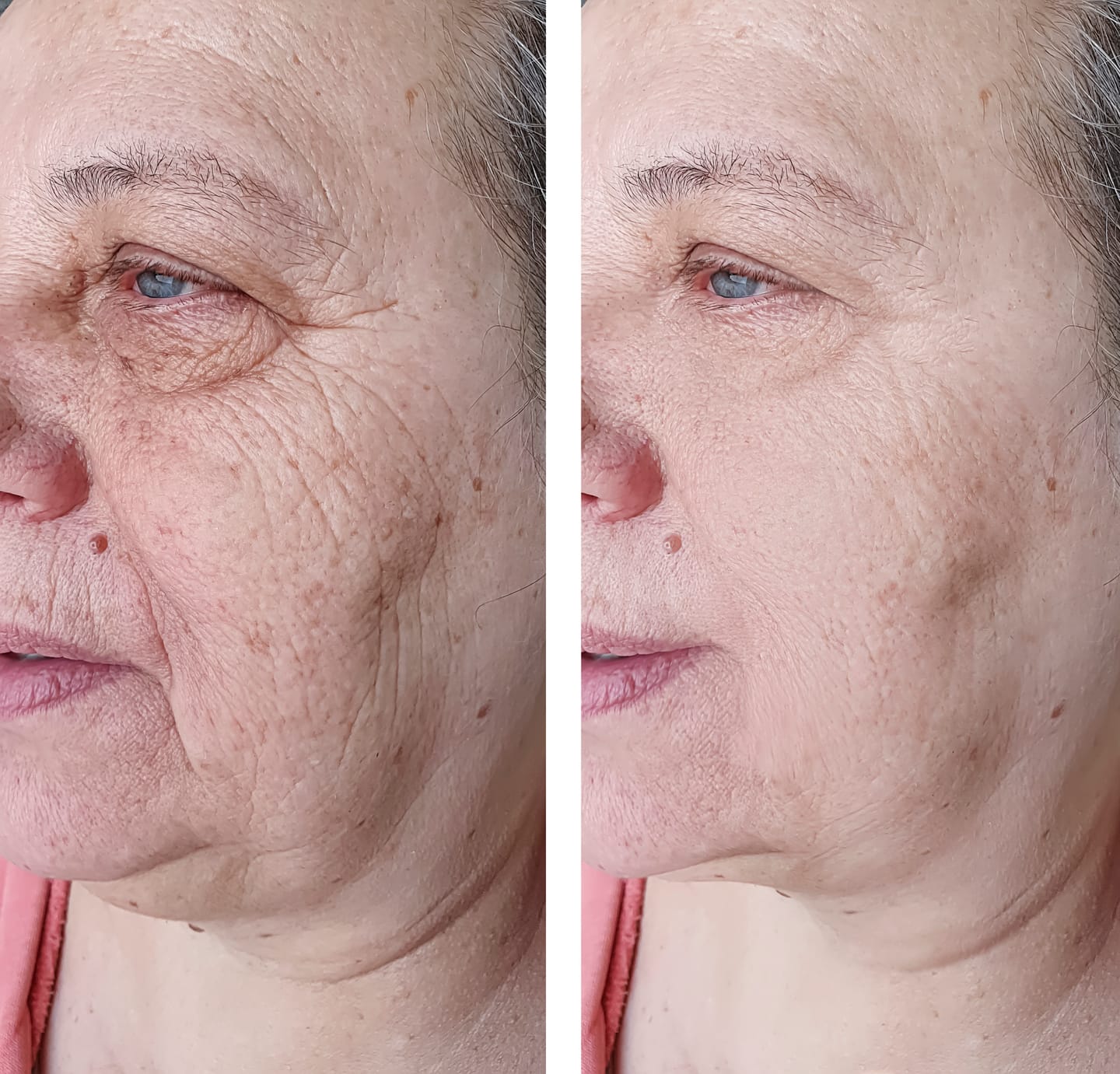 Customer photo review of Microneedling - Lifting Power Set – Professionelles Micro-Infusion Treatment für Zuhause