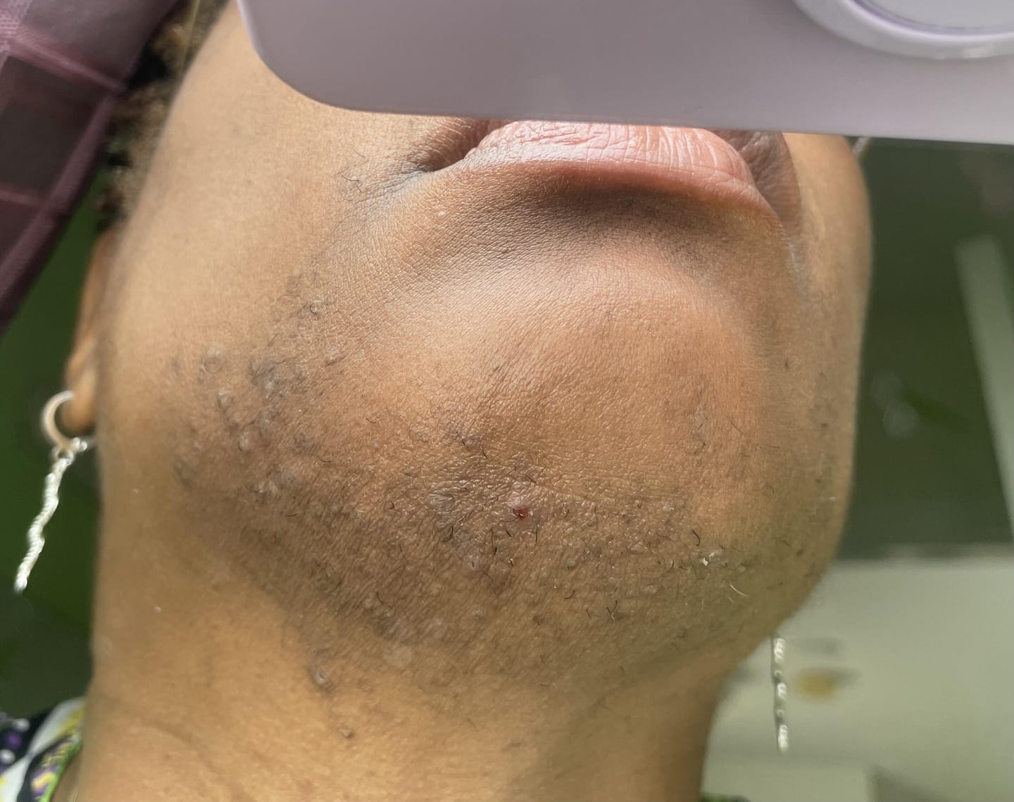 Customer photo review of Facial Moisturizer (Ingrown Hair/Acne)