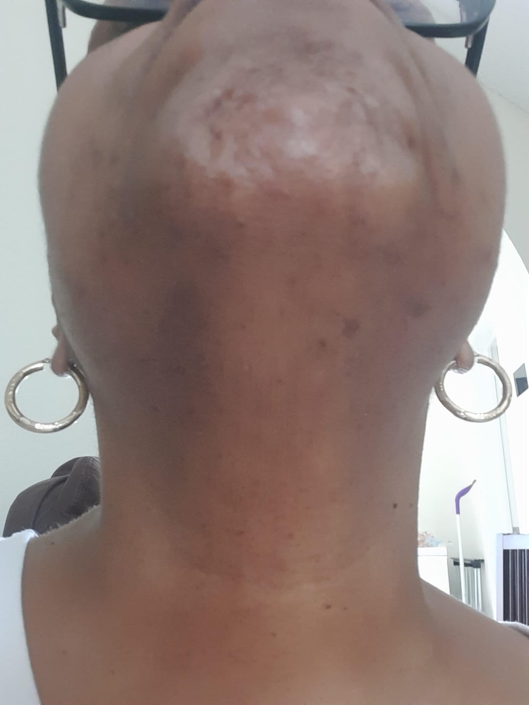 Customer photo review of Hair Reducing Fade Oil - Slows Growth, Thins, and Reduces Hair Naturally