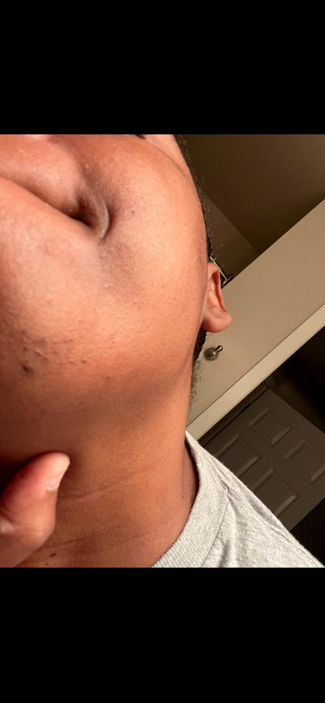 Customer photo review of Hair Reducing Fade Oil - Slows Growth, Thins, and Reduces Hair Naturally