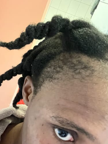 Customer photo review of Minoxidil High Strength (5%) SOLUTION, 3x60ml pack